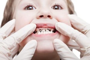 prevenirea cariilor dentare