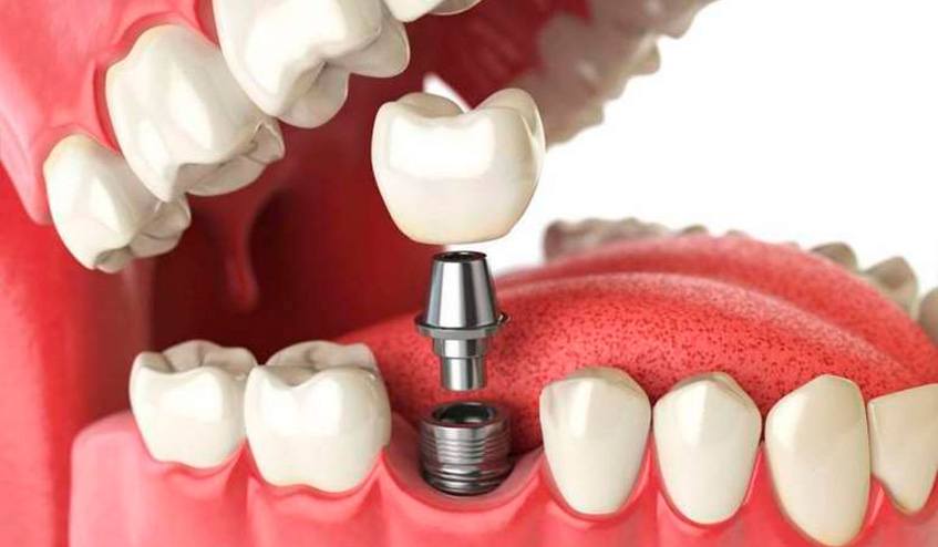 Saki Estetix - Stomatologie - Implant dentar - Clinica Stomatologica Sector 4, Clinica Stomatologica Sector 5